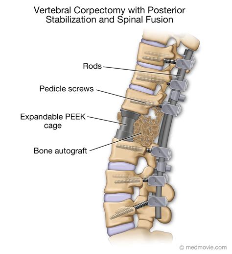 Spine Stabilization: