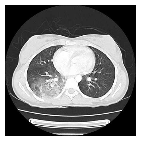 Spiral CT of the Chest Epub