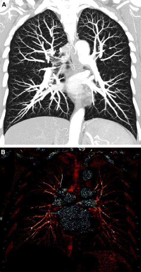 Spiral CT of the Chest Epub