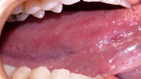 Squamous Cell Cancer Tongue: A Comprehensive Guide