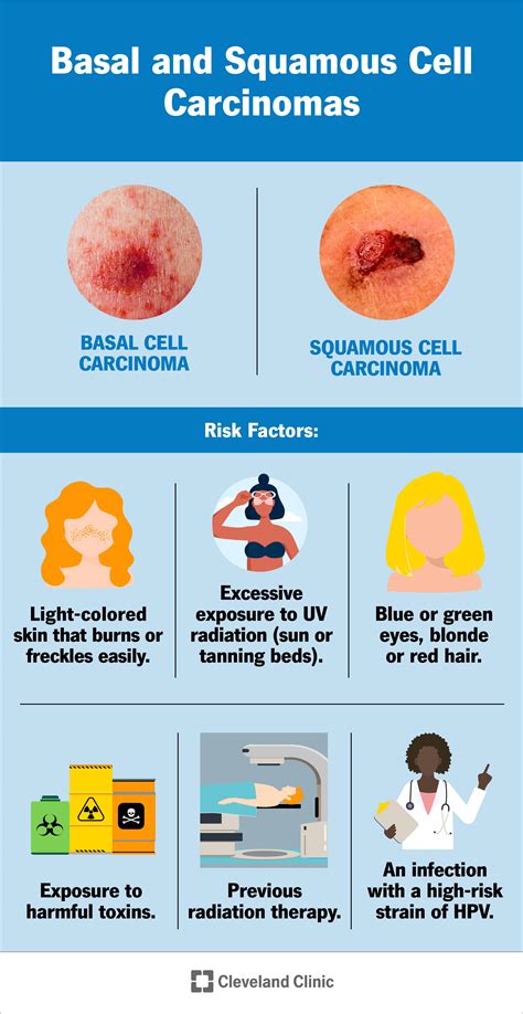 Squamous Cell Carcinoma Nose: 5 Essential Facts You Need to Know