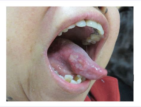 Squamous Cell Carcinoma of the Tongue: A Comprehensive Guide