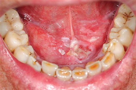 Squamous Cell Mouth Cancer: A Deadly Disease That's More Common Than You Think