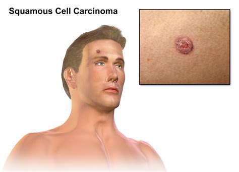 Squamous cell carcinoma: