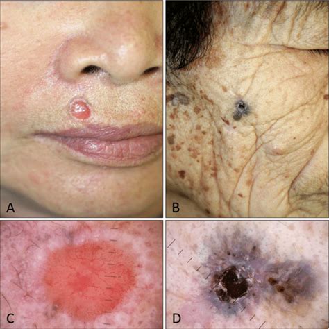 Stage 1 Squamous Cell Cancer