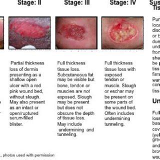 Stage 3 Bedsore Pictures: A Comprehensive Guide