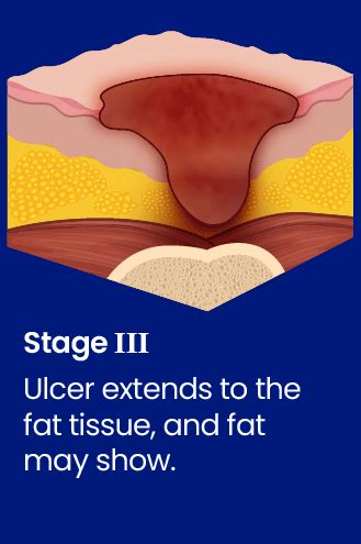 Stage 3 Bedsores: A Comprehensive Visual Guide