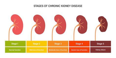 Stage 4 Kidney Failure: A Comprehensive Guide