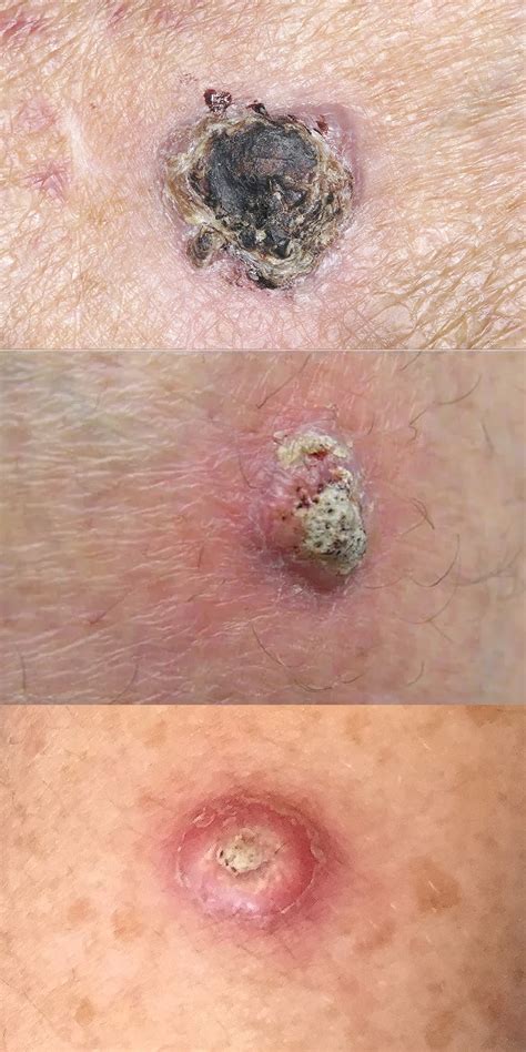 Stage 4 Squamous Cell Carcinoma: A Comprehensive Guide