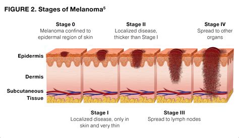 Stage I: