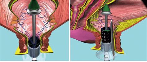 Stapled Transanal Rectal Resection With Contour Transtar Curved Cutter Spapler Procedure Set PDF