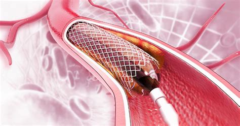 Stent Cardíaco: Um Guia Abrangente para Tratamento, Benefícios e Cuidados