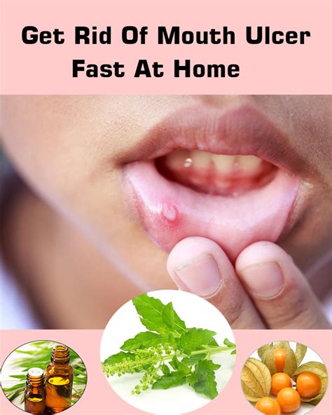 Steps to Cure Lip Ulcers Fast