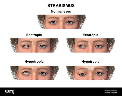 Strabismus: A Veil Over Vision