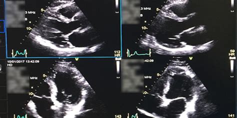 Stress Echocardiography Reader