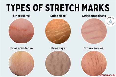 Stretch Marks Doc