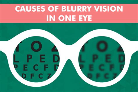 Sudden Blurry Vision in One Eye: A Comprehensive Guide