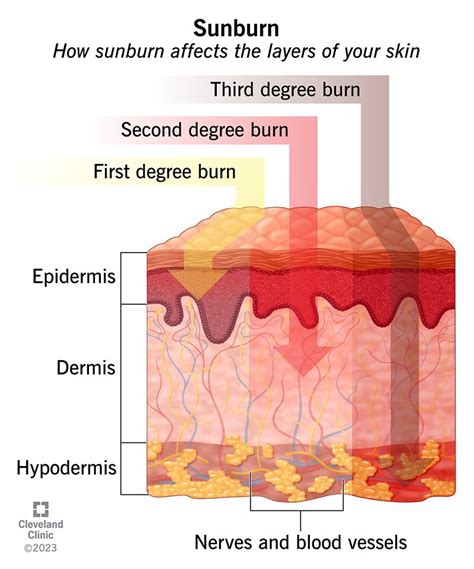 Sunburns: