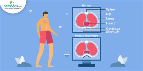 Sunken Chest: A Journey from Diagnosis to Recovery