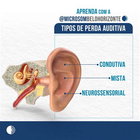 Surdez Unilateral: Entendendo a Perda Auditiva em Um Ouvido