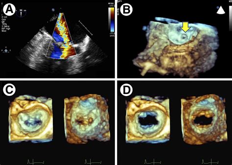 Surgical Echocardiography of Heart Valves: A Primer for the pdf Epub