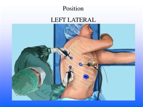 Surgical Thoracoscopy Epub