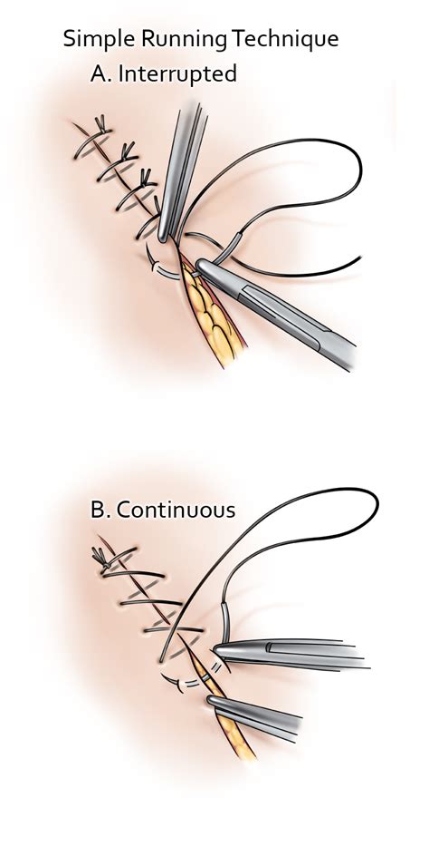 Suturing wounds: