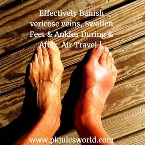 Swollen Ankles During Flight: Causes, Prevention, and Relief