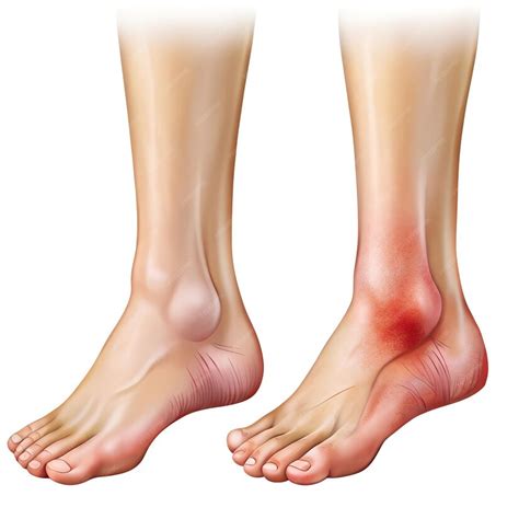 Swollen Ankles From Flight: A Guide to Prevention and Treatment