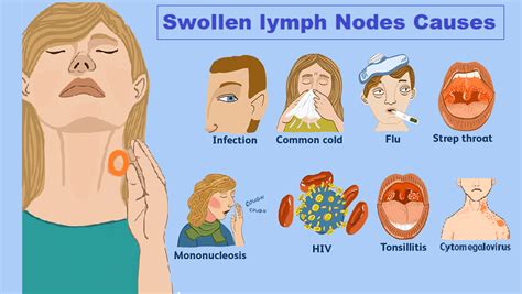 Swollen lymph nodes