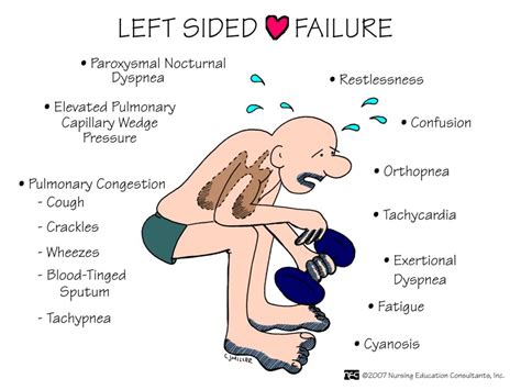 Symptoms of Left-Sided Heart Failure: Over 50 Symptoms