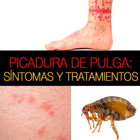 Tabela 1: Sintomas de Picadas de Pulga