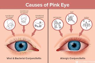 Table 1: Causes of Pink Eye