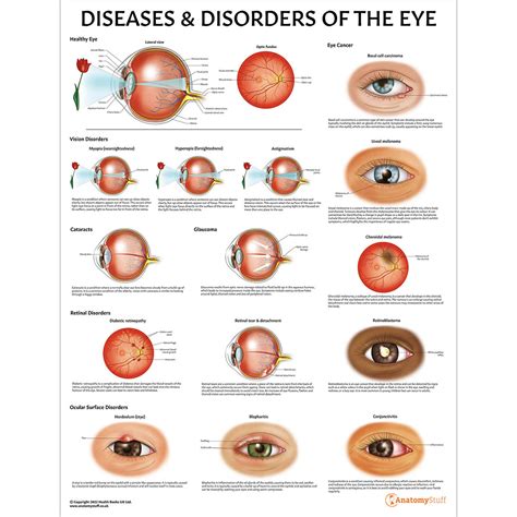 Table 1: Common Eye Conditions and Their Symptoms