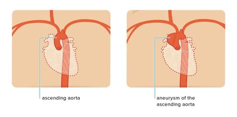 Table 1: ICD-10 Codes for Ascending Aortic Aneurysm