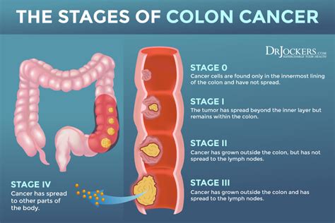 Table 1: Symptoms of Colon Cancer