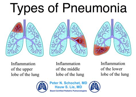 Table 1: Symptoms of Pneumonia