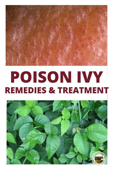 Table 1: Symptoms of Poison Ivy Rash