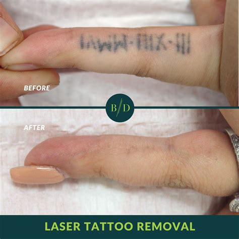 Tattoo Removal Before and After: A Comprehensive Guide