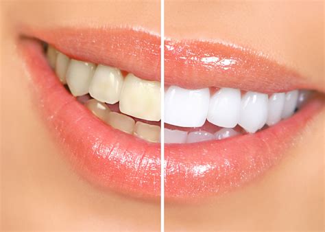 Teeth Whitening: