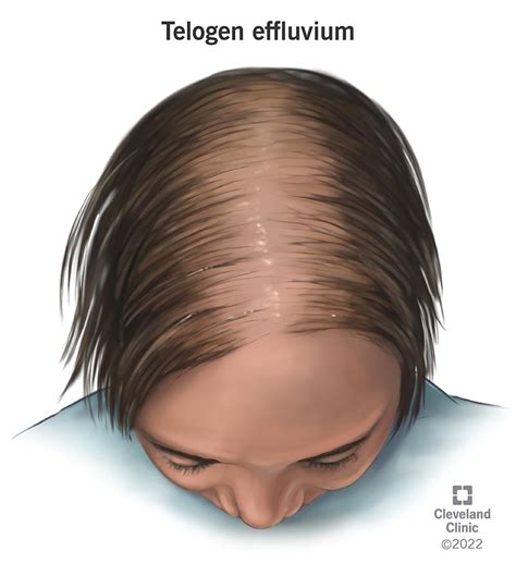 Telogen effluvium