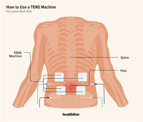 Tens Unit Placement Chart Lower Back