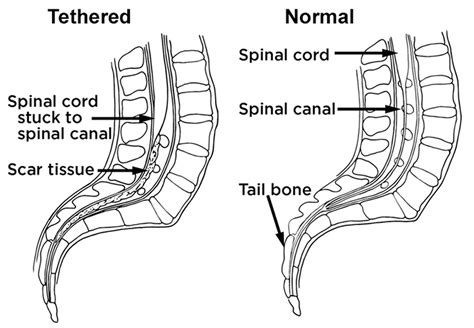 Tethered Cord Syndrome in Children and Adults 2nd Edition Epub