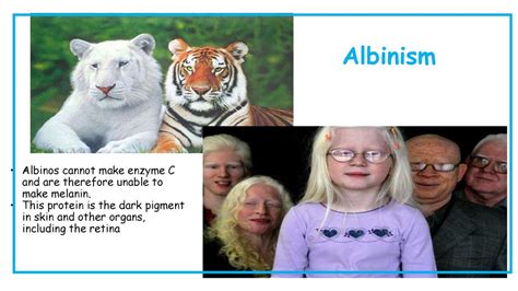 The Biology of Albinism