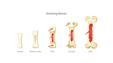 The Bone Epidemic: A Growing Problem