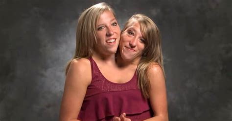 The Catarina Twins: A Comprehensive Guide to Understanding Conjoined Twins