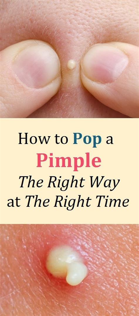 The Comprehensive Guide to Pimple Popping: A Step-by-Step Approach to Safely Removing Stubborn Blemishes