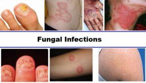 The Dan Dangler Nude: A Comprehensive Guide to Fungal Infections