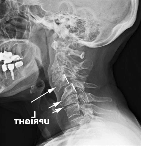 The Degenerative Cervical Spine PDF