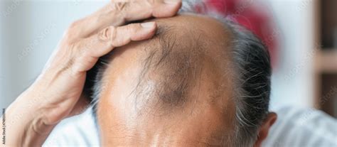 The Distress of Thinning Hair